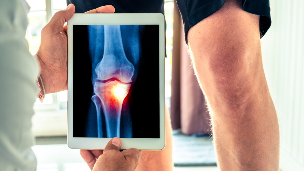 rehabilitacja po endoprotezie kolana